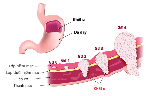 5 biểu hiện của bệnh ung thư dạ dày ai cũng cần biết