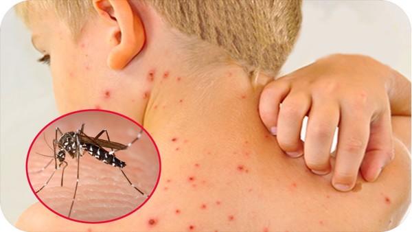 Cảnh báo ngộ độc thuốc hạ sốt, giảm đau trong điều trị sốt xuất huyết