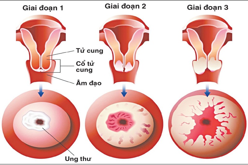 Các loại xét nghiệm ung thư cổ tử cung phổ biến nhất hiện nay